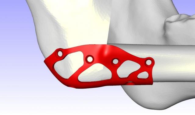 Abschluss des Forschungsprojekts TOPOS – Topologieoptimierte Osteosynthesen