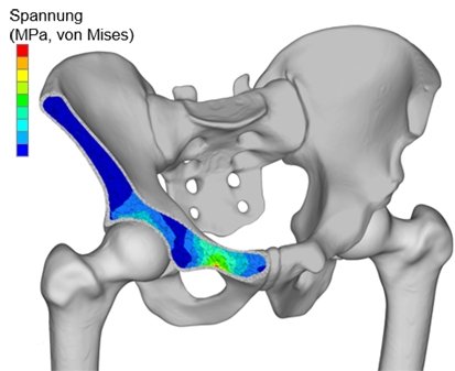 ASIMOV - Anatomiespezifische Implantatverankerung mittels optimierter Verformungseigenschaften